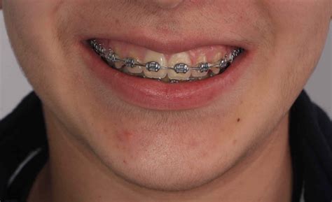 brackets metalicos precios